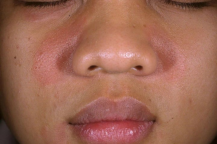 Best cream for seborrheic dermatitis on face in jar with gentle formula