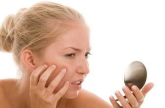 Natural remedies to get rid of acne scars, including aloe vera, honey, and turmeric for clear skin.