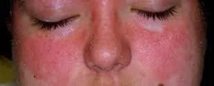 Natural ingredients in cream for seborrheic dermatitis on face