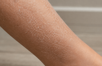 What causes dry skin on the legs — close-up of dry, flaky skin on a person's lower leg